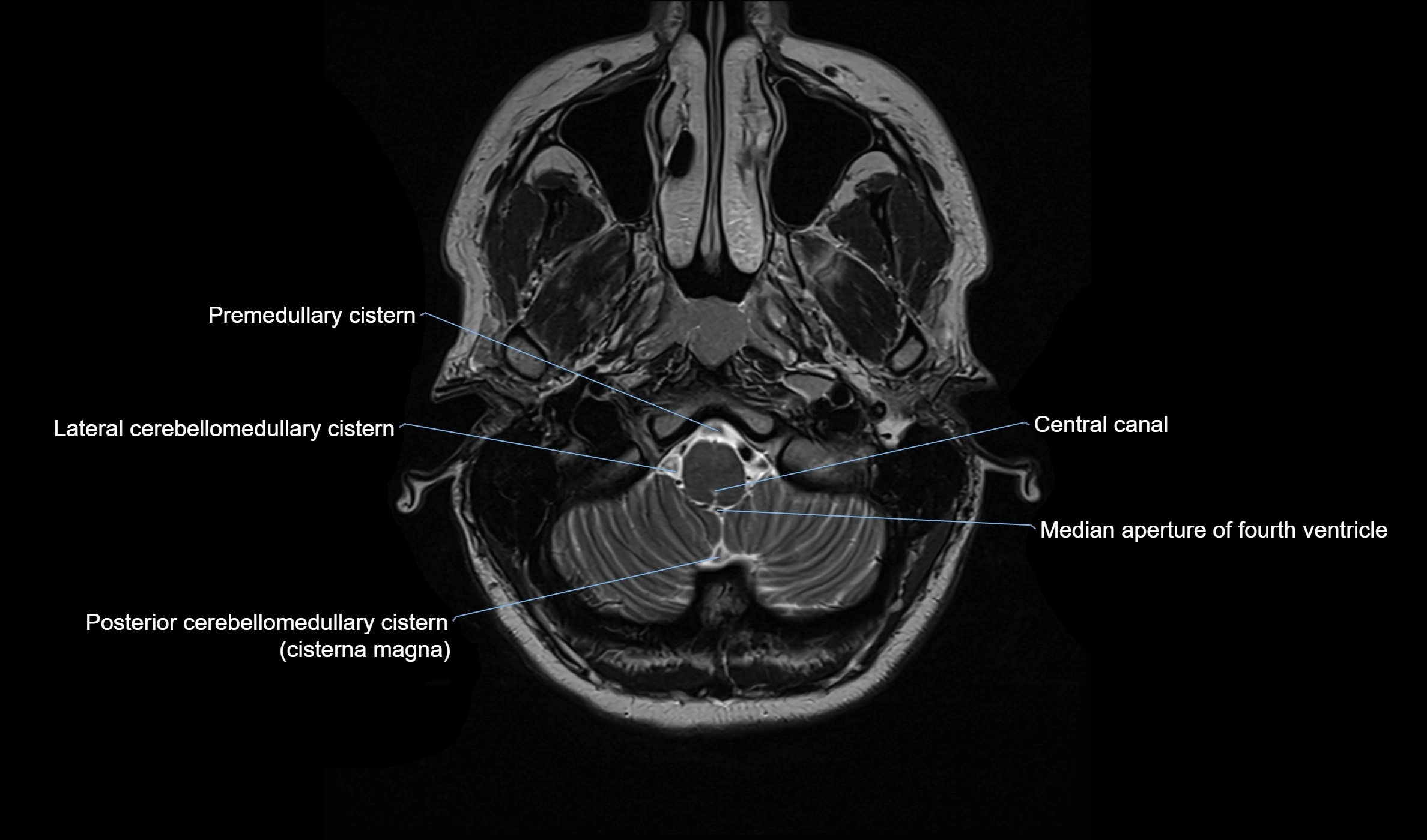 Brain cisterns  and ventricles  axial anatomy 3T MRI image-img-00001-00004.webp